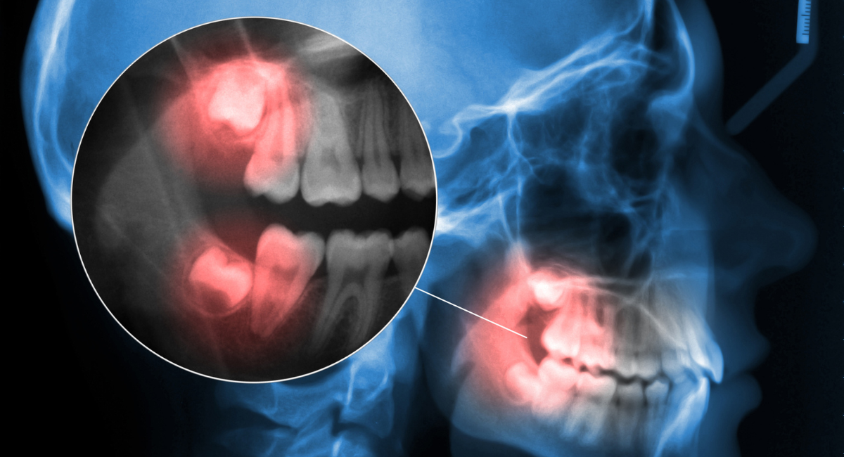 「親知らずが気になる…」そう感じたあなたへ