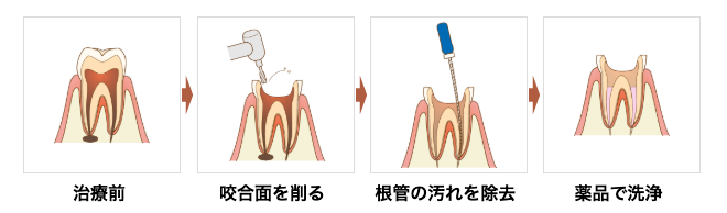 根管治療1回目 ― 根管内の清掃・殺菌