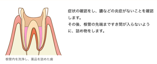 根管治療2回目 ― 根管充填