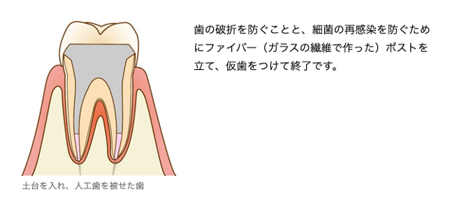 根管治療土台作り