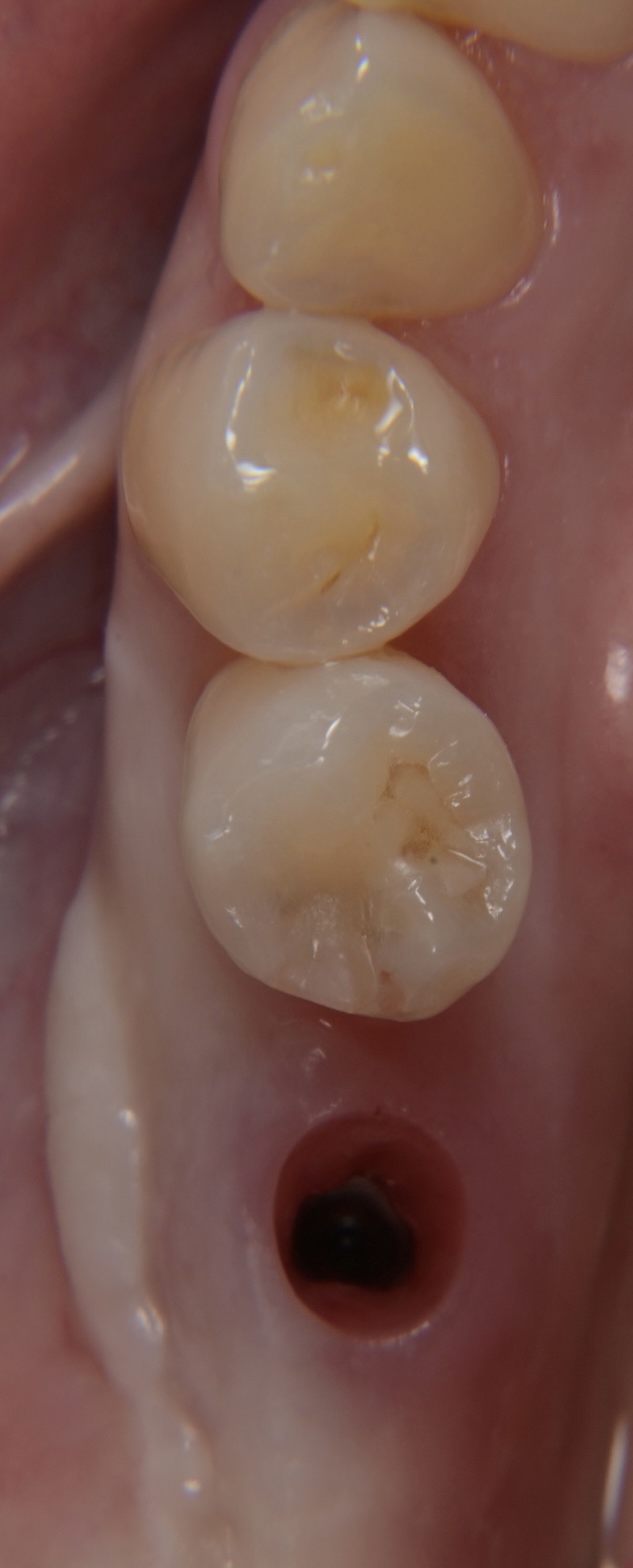 インプラント治療（FGG）