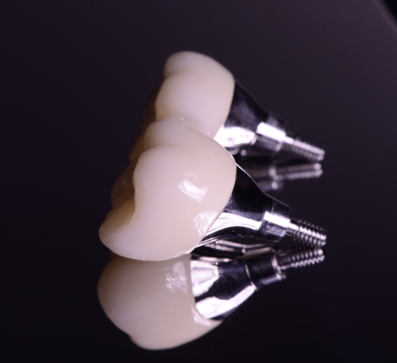 インプラント（Socket Lift）