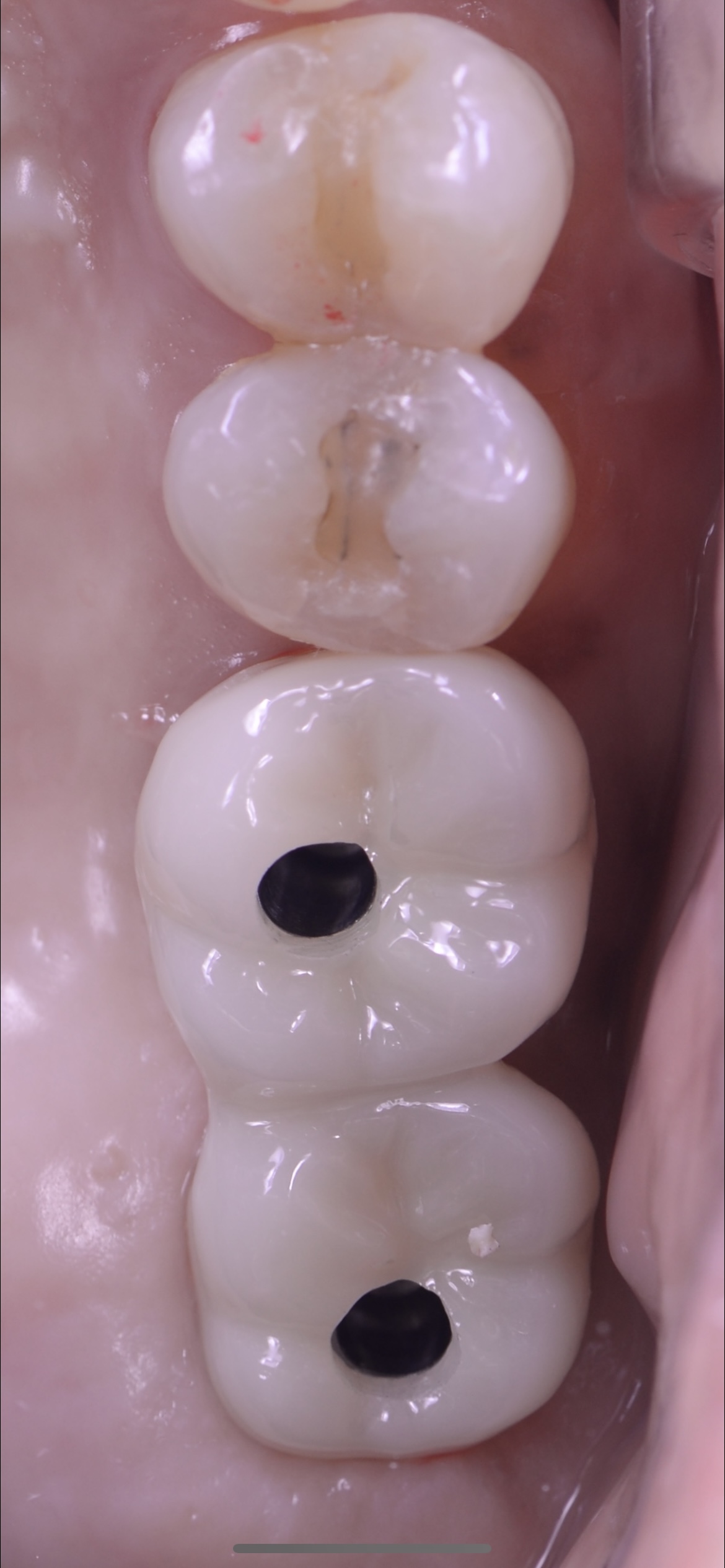 インプラント（Socket Lift）