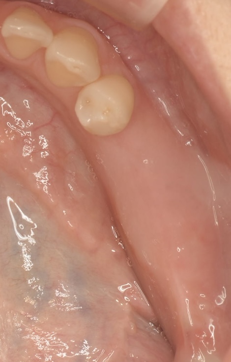 インプラント（単純埋入２本）