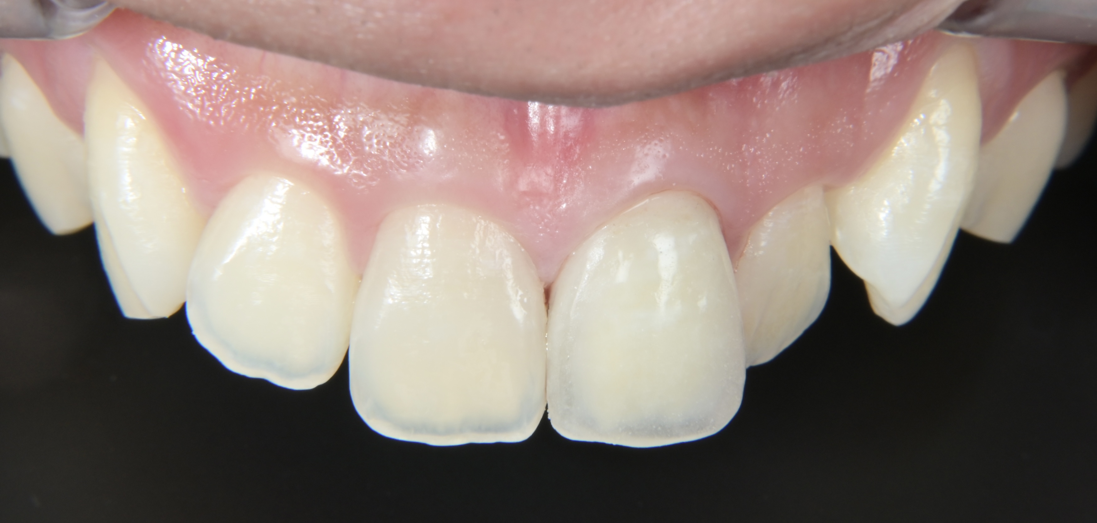 外傷（MTA＆オールセラミッククラウン）