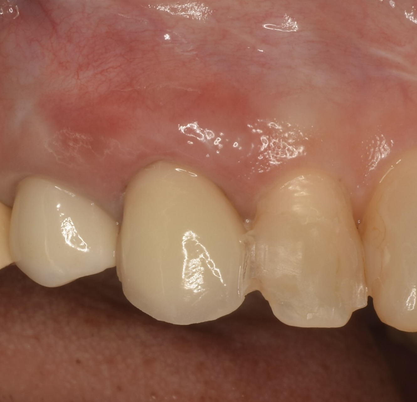 前歯インプラントSST（Socket Shield Technique））