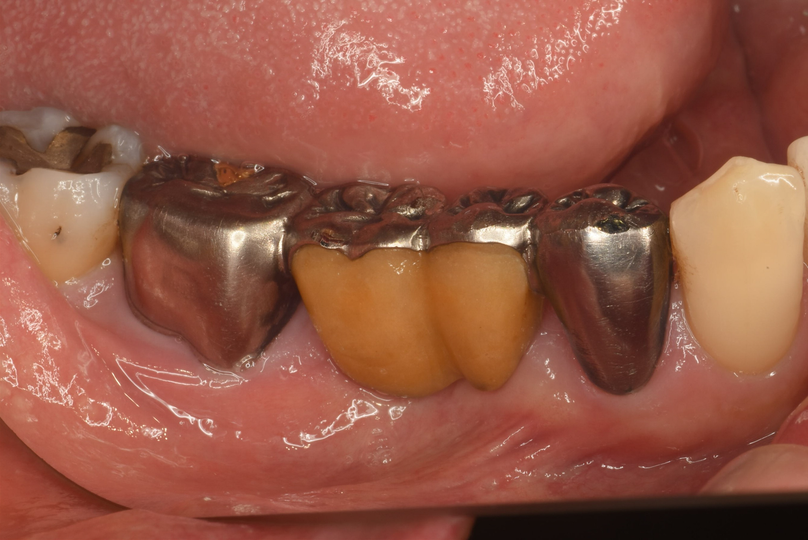 インプラント（GBR＆FGG）