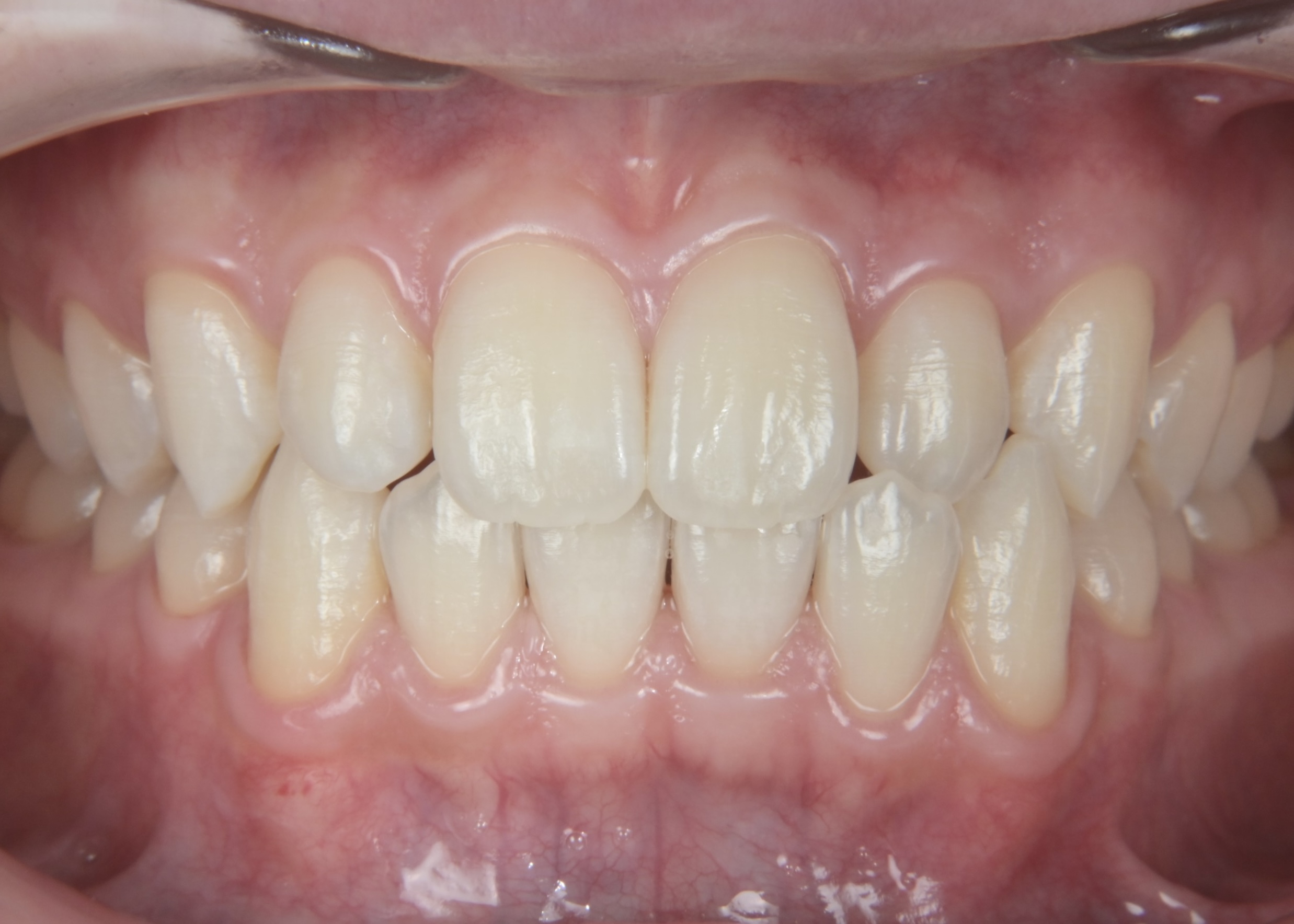 ホワイトニング