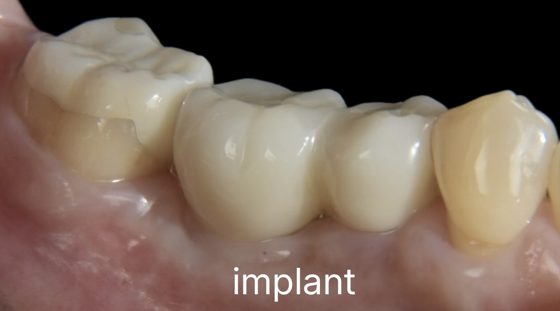 インプラント治療